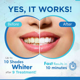 EZGO Teeth Whitening Kit
